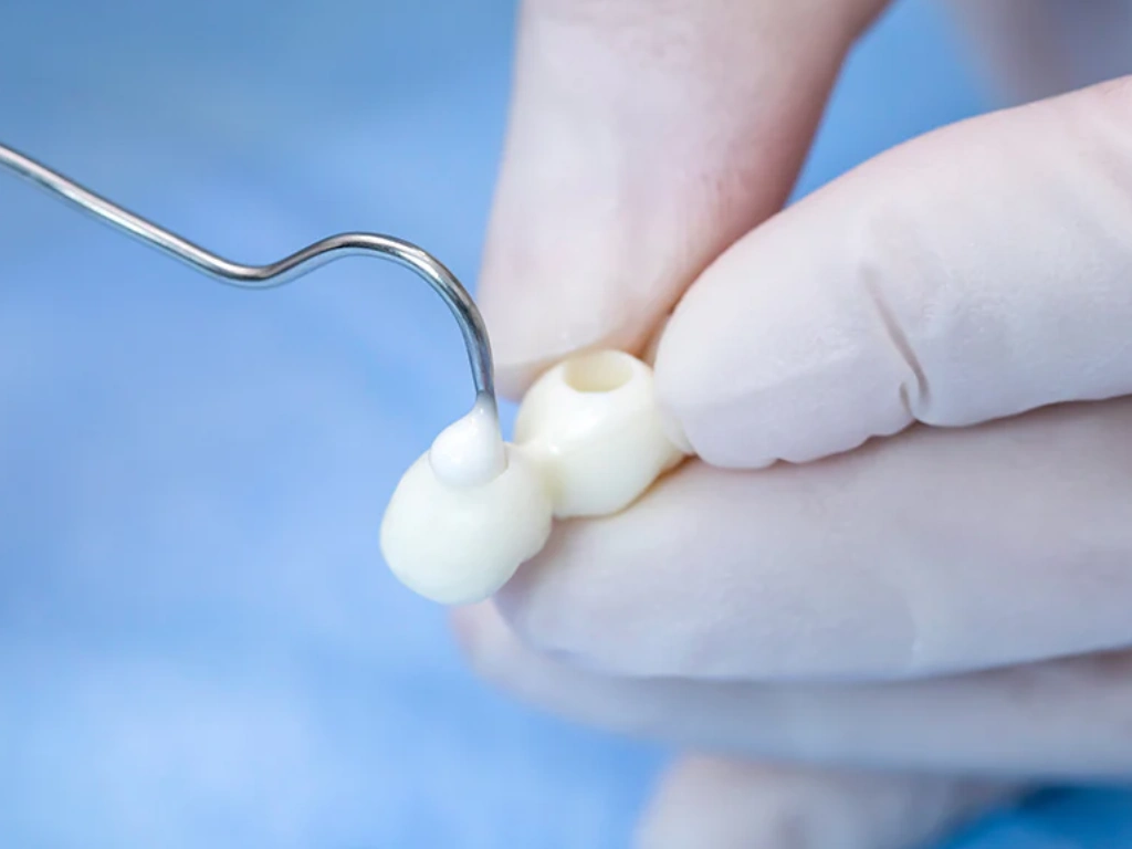 Quá trình bọc sứ sử dụng keo dán khó có thể tháo tại nhà